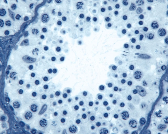 <strong>In Fig. Img_007, this is a healthy region in a patient suffering from cancer of the </strong> A) ovary B) testis C) prostate D) cervix E) breast
