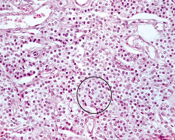 <strong>The cells located within the circle produce which of the following?  </strong> A) antibodies B) calcitonin C) parathyroid hormone D) osteoclast-stimulating factor E) norepinephrine <div style=padding-top: 35px> 