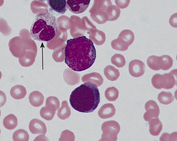 <strong>The cell indicated by the arrow is a </strong> A) neutrophil B) neutrophilic metamyelocyte C) eosinophilic metamyelocyte D) eosinophilic myelocyte E) promyelocyte
