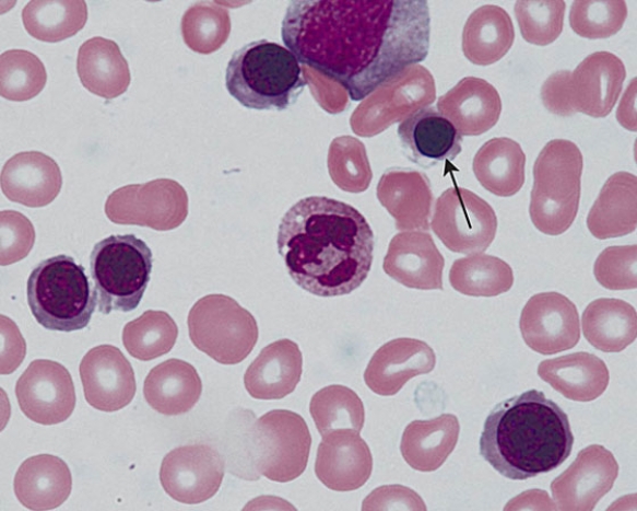 <strong>The cell at the tip of the arrow is a </strong> A) lymphocyte B) basophilic erythroblast C) promonocyte D) polychromatophilic erythroblast E) orthochromatophilic erythroblast