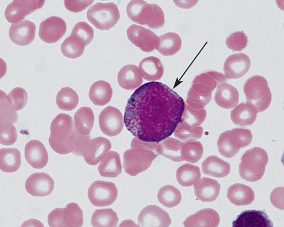 <strong>The cell at the tip of the arrow is a(n) </strong> A) eosinophilic metamyelocyte B) neutrophilic metamyelocyte C) basophilic metamyelocyte D) promyelocyte E) myeloblast