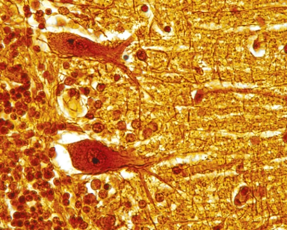 <strong>In Fig. Img_003, a patient who has a stroke involving this region of the central nervous system has damage to her </strong> A) cerebrum B) cerebellum C) spinal cord D) thalamus E) hypothalamus