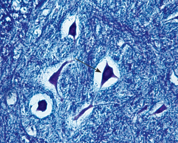 <strong>Identify the cell at the tip of the arrow </strong> A) unipolar neuron B) pseudounipolar neuron C) bipolar neuron D) interneuron E) multipolar neuron