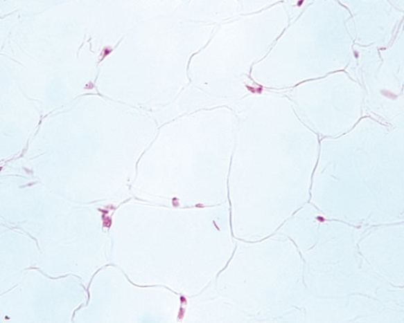 <strong> A patient presents with a painless, well circumscribed, movable tumor the size of a golf ball on her shoulder. The physician takes a biopsy and the histological image is as displayed.  The diagnosis is</strong> A) chondroma B) lipoma C) rhabdomyosarcoma D) liposarcoma E) melanoma <div style=padding-top: 35px> 