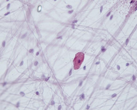 <strong>In Fig. Img_014, the large red cell in the middle of the field is responsible for which of the following conditions?  </strong> A) anaphylactic shock B) osteoblastoma C) leukemia D) chondroblastoma E). fibroma <div style=padding-top: 35px> 