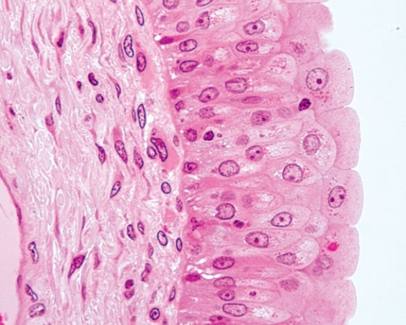 <strong>In Fig. Img_006, this is a healthy region in a patient suffering from cancer of the  </strong> A) esophagus B) skin C) urinary bladder D) gallbladder E) cervix <div style=padding-top: 35px> 