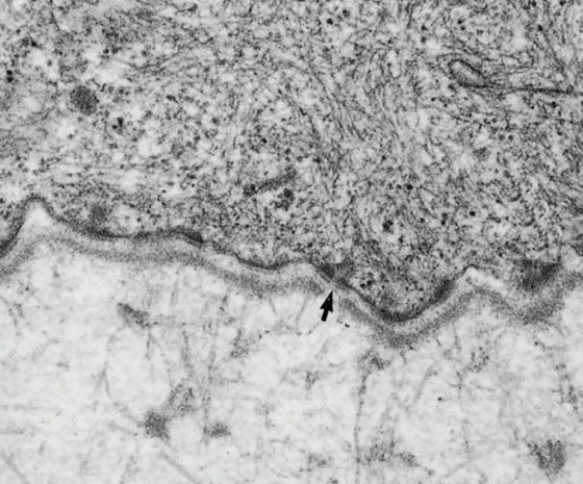 <strong>An elderly patient is seen by his dermatologist because he developed itching and blisters on his skin. If the blistering involves the region indicated by the arrows in this electron micrograph (Basallamina4), and if the patient is shown to have IgG along the same area indicated by the arrows, the patient is probably suffering from </strong> A) dermatitis herpetiformis B) atopic dermatitis C) pemphigus vulgaris D) pemphigus foliaceus E) bullous pemphigoid