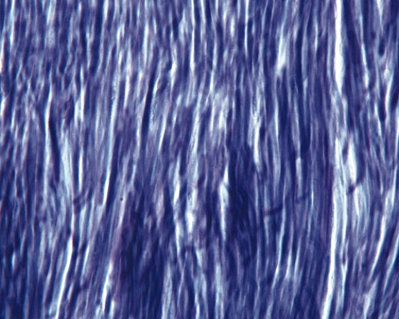 <strong>In Fig. Img_016, which of the following familial disorders is due to abnormal development of the tissue represented in the accompanying photomicrograph? </strong> A) Ehler-Danlos syndrome B) Marfan syndrome C) osteogenesis imperfecta D) Stickler's syndrome E) benign hypermobility syndrome