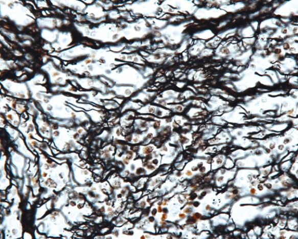 <strong>In Fig. Img_017, the predominant connective tissue element shown in this photomicrograph is a type of collagen fiber. Which type of collagen fiber is it? </strong> A) type I B) type II C) type III D) type IV E) type VII