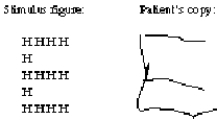 <strong>Here are a hierarchical letter figure and a copy of this stimulus drawn by a person with a unilateral brain injury.Where is the most probable location of this injury? </strong> A)The right dorsolateral frontal lobe B)The left temporoparietal cortex C)The right fusiform gyrus D)The left occipital lobe