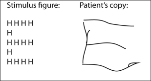 <strong>Here are a hierarchical letter figure and a copy of this stimulus drawn by a person with a unilateral brain injury. Where is the most probable location of this injury? </strong> A) the right dorsolateral frontal lobe B) the left temporoparietal cortex C) the right fusiform gyrus D) the right occipital lobe