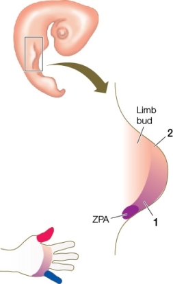 <strong>Use the following to answer questions : Refer to the figure below showing a stage in limb development in a human embryo. If the ZPA secreted more morphogen than normal,the most likely result would be</strong> A) two thumbs. B) five thumbs. C) five digits but no thumb. D) no little finger. E) no digits.