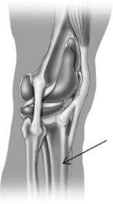 <strong>The structure that is highlighted in this illustration of a knee joint is a </strong> A)bone. B)ligament. C)tendon. D)synovial sac.