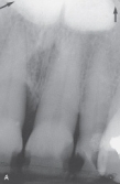 <strong>This bony hard radiopaque structure in the midline of the hard palate is genetic in origin and inherited in an autosomal dominant manner. The diagnosis is made through clinical appearance. You suspect a:</strong> A)palatal cyst. B)torus palatinus. C)mixed tumor. D)ranula.
