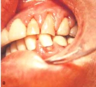 <strong>The gingival enlargement in this patient was caused by a calcium channel blocker. Which one of the following would likely be the cause?</strong> A)Dilantin B)Nifedipine C)Quinidine D)Clozapine