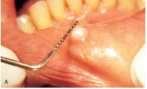 <strong>The base of this lesion would be described as: </strong> A)pedunculated. B)lobule. C)bulla. D)sessile.