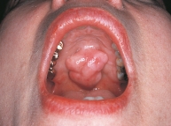<strong>This torus palatinus would be described as: </strong> A)bullous. B)papular. C)lobulated. D)nodular.