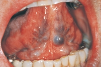 <strong>These reddish-purple clusters observed on the ventral surface of the tongue and diagnosed through clinical observation are referred to as which of the following variants of normal conditions? </strong> A)Palatal cyst B)Mandibular tori C)Lingual varicosities D)Ranula
