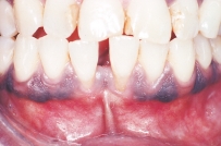 <strong>The variant of normal coloration seen on the mandibular gingival surface of this patient is referred to as: </strong> A)lingual varicosities. B)leukoedema. C)melanin pigmentation. D)linea alba.