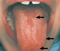 <strong>This pathological lesion seen on the dorsal surface of the tongue is characteristic of: </strong> A)fissured tongue. B)hairy tongue. C)median rhomboid glossitis. D)migratory glossitis.