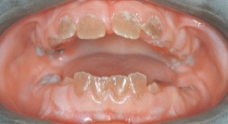<strong>While obtaining diagnostic information from a patient, the dental hygienist learns that the appearance of this patient's teeth is familial. The correct diagnosis is: </strong> A)tetracycline staining. B)pulpal dysplasia. C)extrinsic staining. D)dentinogenesis imperfecta.