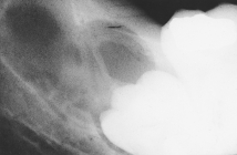 <strong>The name of this benign tumor that is slow growing but locally aggressive and derived in association with an impacted tooth and dentigerous cyst is: </strong> A)calcifying odontogenic cyst. B)odontogenic myxoma. C)compound odontoma. D)ameloblastoma.