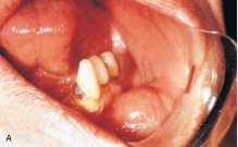 <strong>This benign tumor of fat cells that clinically appears as a yellowish mass surfaced by a thin layer of epithelium is referred to as a: </strong> A)chondroma. B)rhabdomyosarcoma. C)lipoma. D)lymphoma.