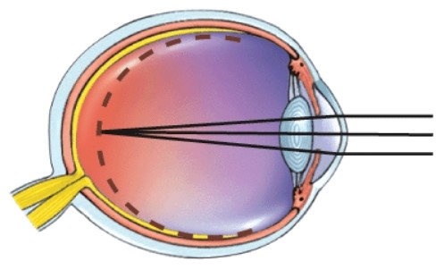 <strong>What is this a picture of? </strong> A)Nearsightedness B)Farsightedness C)Astigmatism D)Normal vision