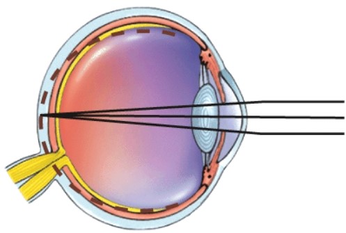 <strong>What is this a picture of? </strong> A)Nearsightedness B)Farsightedness C)Astigmatism D) Normal vision