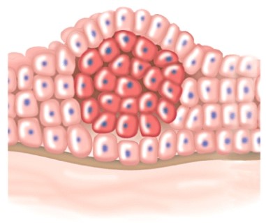 <strong>The tumor in the illustration is: </strong> A)malignant. B)metastatic. C)benign. D)exhibiting contact inhibition.