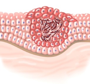 <strong>This process is called: </strong> A)hyperplasia. B)malignant. C)apoptosis. D)in situ.