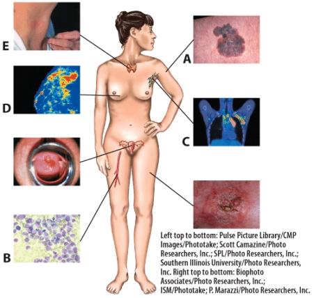 <strong>Leukemia is indicated by which letter in the picture? </strong> A)A B)B C)D D)E