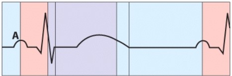 <strong>What is happening during the phase labeled A? </strong> A)Semilunar valve closure B)AV valve closure C)Atrial depolarization D)Ventricular repolarization