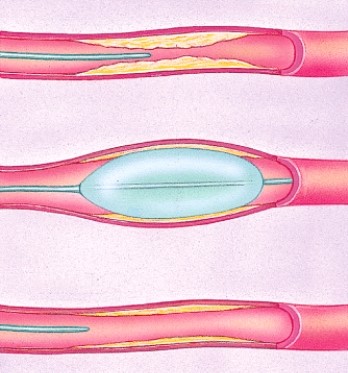 <strong>What is the name of this procedure? </strong> A)By-pass surgery B)Placement of a stent C)Balloon angioplasty D)Defibrillation