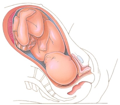 <strong>Which stage of labor is depicted here? </strong> A)Dilation B)Expulsion C)Placental D)Birth
