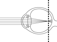   The figure above is a diagram of an abnormal eye that would result in vision problems. A person with this condition would be considered farsighted and would require convex lenses in order to see objects in the distance.<div style=padding-top: 35px> 