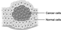 The tumor shown in the figure above is most likely malignant.
