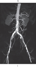 <strong>The figure below is an example of which of the following? </strong> A) Multiplanar reformation B) Shaded surface display C) Maximum intensity projection D) Volume rendering