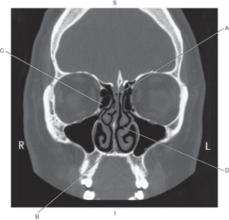 <strong>Questions 31 through 33 refer to the figure below of a coronal CT of the ethmoid bone. Which arrow points to the vomer?</strong> A) A B) B C) C D) D