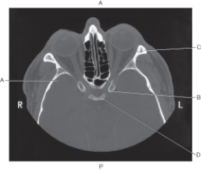<strong>Questions 34 through 36 refer to the figure below of an axial CT of the orbit. Which arrow points to the anterior clinoid process?</strong> A) A B) B C) C D) D