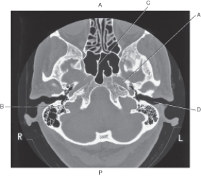<strong>Questions 37 through 39 refer to the figure below of an axial CT of the temporal bone. Which arrow points to the carotid canal?</strong> A) A B) B C) C D) D