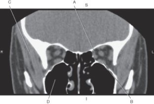 <strong>Questions 37 through 39 refer to the figure below of an axial CT of the temporal bone. On the figure below,a coronal CT of the orbit with optic nerve and vessels,which arrow points to the temporalis muscle? </strong> A) A B) B C) C D) D