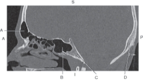 <strong>Questions 41 through 44 refer to the figure below of a sagittal CT reformat of the cranium. Which arrow points to the occipital bone?</strong> A) A B) B C) C D) D