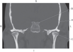 <strong>Questions 45 through 47 refer to the figure below of the coronal CT of the dorsum sella. Which arrow points to the temporal bone?</strong> A) A B) B C) C