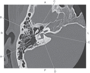 <strong>Questions 48 through 52 refer to the figure below of an axial CT of the inner ear. Which arrow points to the mastoid antrum?</strong> A) A B) B C) C D) D E) E