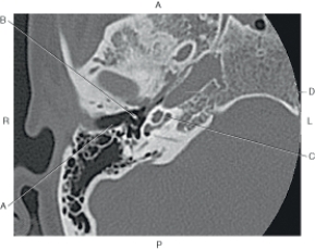 <strong>Questions 53 through 56 refer to the figure below of an axial CT of the inner ear. Which arrow points to the carotid canal?</strong> A) A B) B C) C D) D