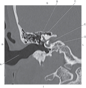 <strong>Questions 57 through 61 refer to the figure below of a coronal CT of the inner ear. Which arrow points to the superior semicircular canal?</strong> A) A B) B C) C D) D E) E