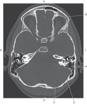 <strong>Questions 62 through 65 refer to the figure below of an axial CT of the cranium. Which arrow points to the lambdoidal suture?</strong> A) A B) B C) C D) D