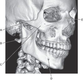 <strong>Questions 66 through 70 refer to the figure below of a 3D CT of the oblique aspect of the facial bones. Which arrow points to the zygoma?</strong> A) A B) B C) C D) D E) E