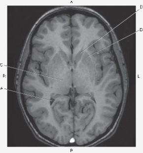 <strong>Questions 13 through 15 refer to the figure below of an axial MR of the brain.   Which arrow points to thalamus?</strong> A) A B) B C) C D) D <div style=padding-top: 35px> 